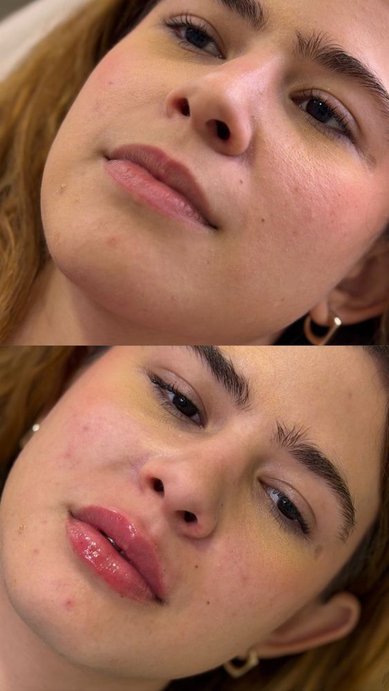 Preenchimento labial, antes e depois